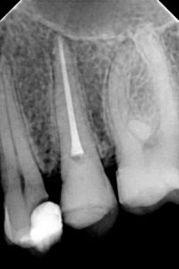 Snimak zuba i korijena