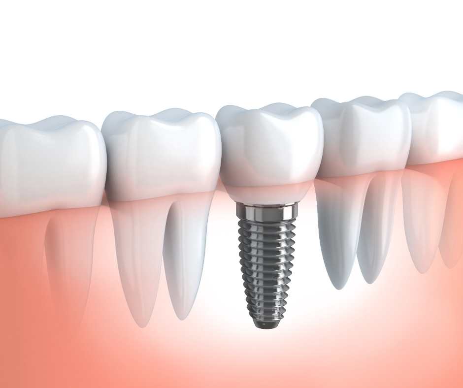 Implantati za zube