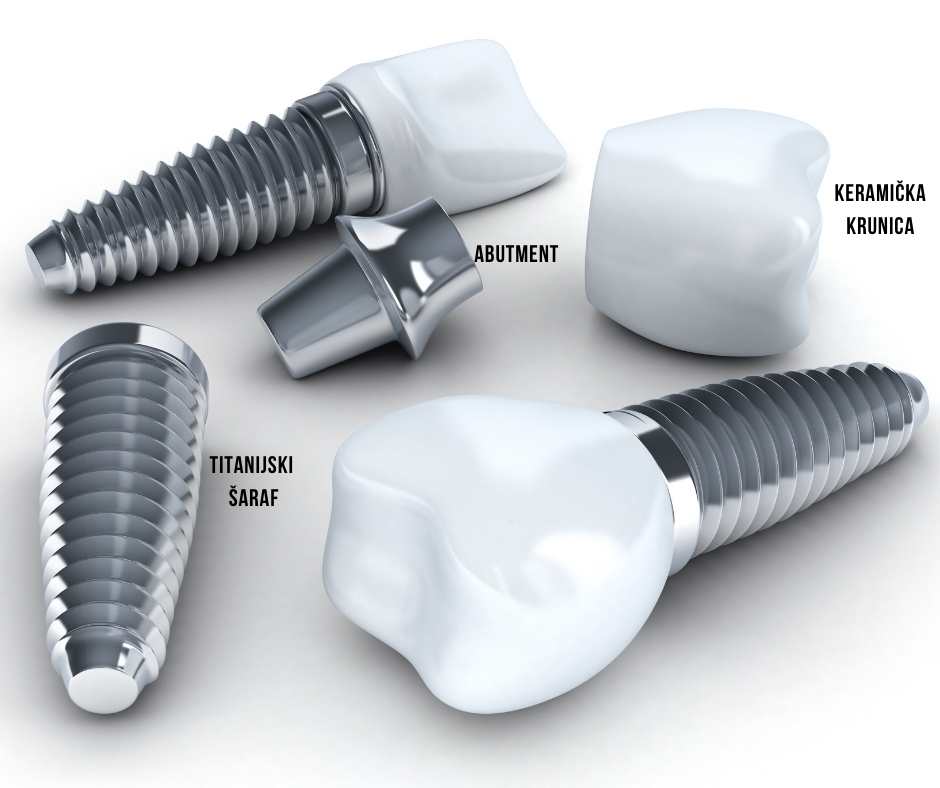 Implantati za zube