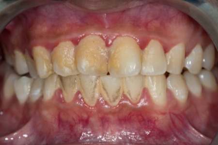 Zubni plak